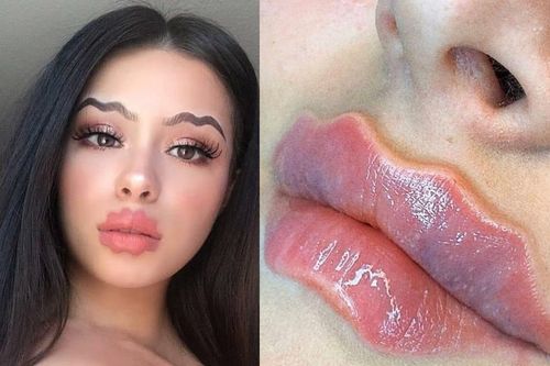 Mốt làm môi bạch tuộc của nhiều cô gái gây tranh cãi