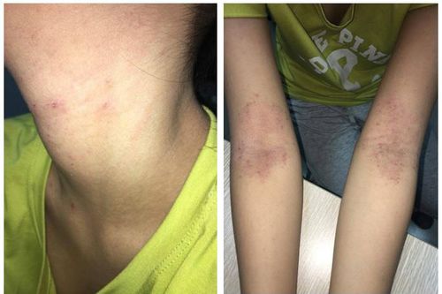 Cách chăm sóc đúng cách với da khô nẻ vào mùa đông
