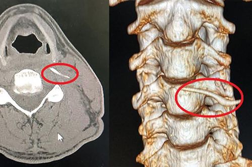 Uống 'nước thần' chữa hóc xương, người đàn ông nhập viện khẩn cấp