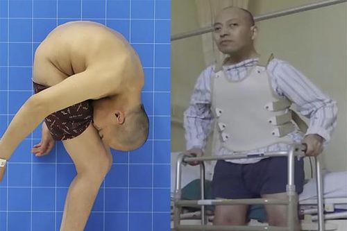 28 năm áp mặt vào đùi, người đàn ông phải tháo cột sống rồi ghép lại