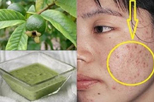 Lấy nắm lá ổi làm theo cách này, mụn đầu đen sẽ bị đánh bật nhanh chóng trả lại làn da trắng mịn như mơ