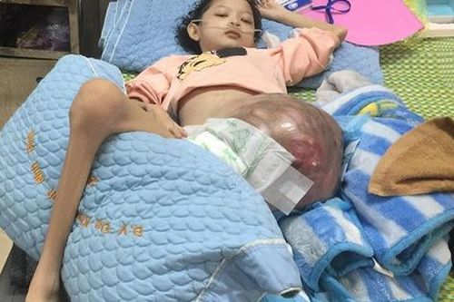 Cô bé Lưu Thị Hồng Phương bị ung thư xương bệnh tiến triển nặng