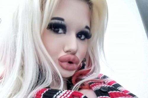 9X tiêm axit 17 lần để có đôi môi lớn nhất thế giới