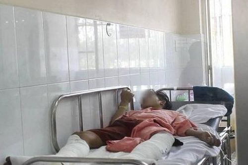 Hút thuốc khi chiết xăng, 4 người trong gia đình bỏng nặng