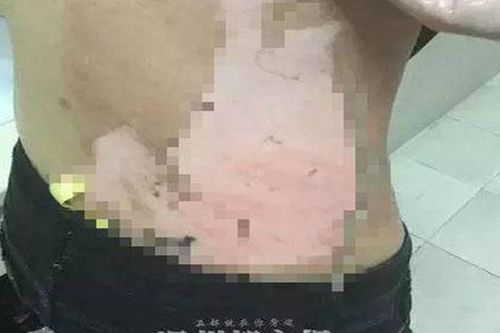 Khởi tố đối tượng hắt ấm nước sôi vào mặt vợ