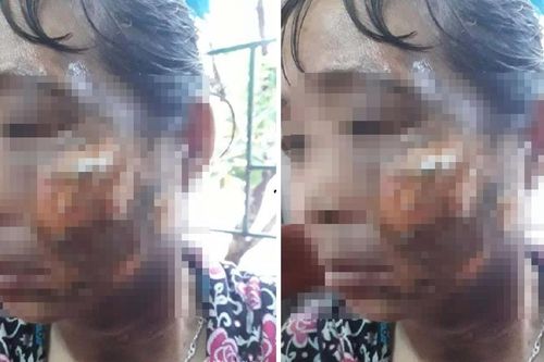 Không được ăn ốc, gã chồng nhẫn tâm hất ấm nước sôi vào mặt vợ