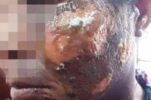 Say rượu, dùng nước sôi tưới lên mặt vợ