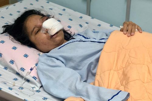 Cô giáo mầm non mắc bệnh lạ khiến gương mặt biến dạng