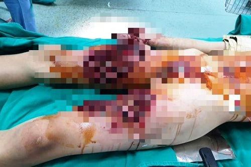 Học sinh bị nát bàn tay do làm pháo