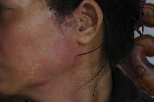 Nỗi đau của người vợ bị chồng nhẫn tâm hắt nước sôi vào mặt