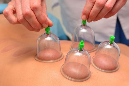 Được chồng giác hơi lúc nửa đêm về sáng, vợ bị bỏng