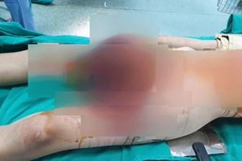 Dùng 50 bao diêm làm thuốc pháo, bé 13 tuổi bị nổ nát bàn tay