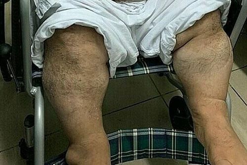 Lần đầu tiên phẫu thuật bắc cầu động mạch vành cho người bệnh béo phì