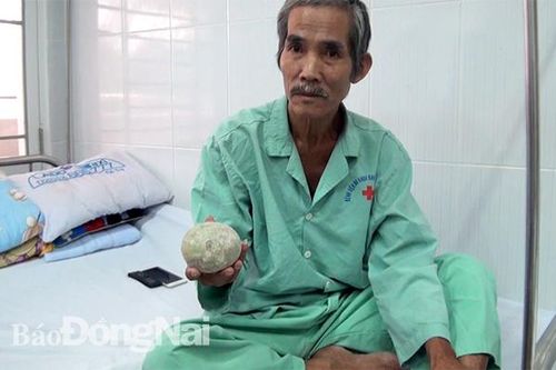 Mổ lấy viên sỏi 'khủng', nặng 0,5 kg