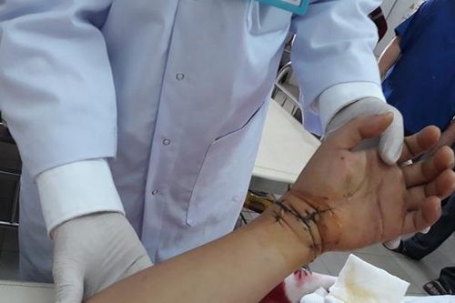Khởi tố 9X chém lìa tay người khác