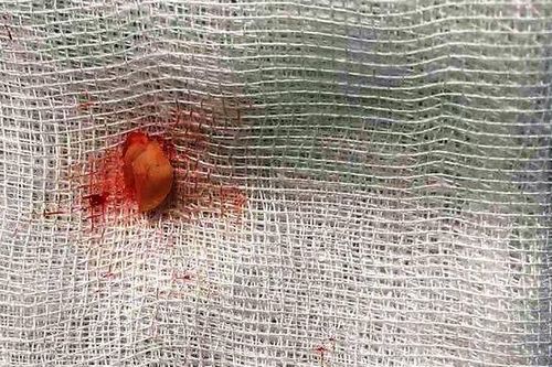 Bé gái 3 tuổi bị hóc hạt đậu phộng suốt 2 tháng