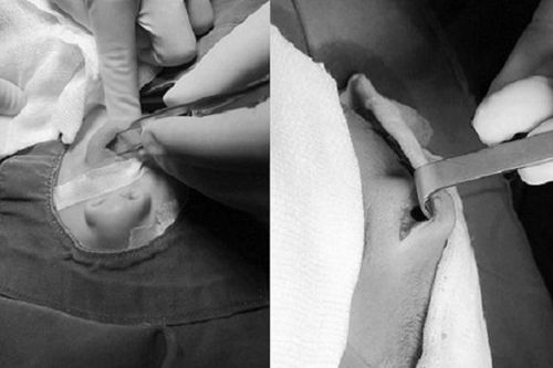 Liên tiếp cấp cứu trẻ bị tai nạn sinh hoạt