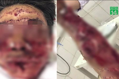 Sử dụng pháo tự chế, người đàn ông bị nổ nát mặt
