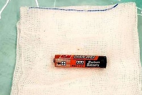 Bé gái 4 tuổi nuốt cục pin vào bụng