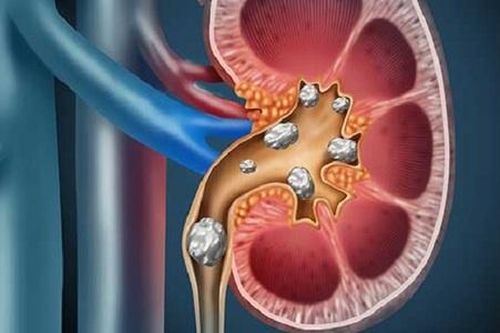 Sỏi san hô phân nhánh trong thận của nữ bệnh nhân