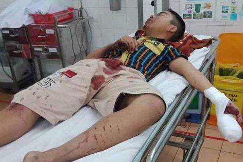 Pháo tự chế phát nổ trên tay thiếu niên 14 tuổi