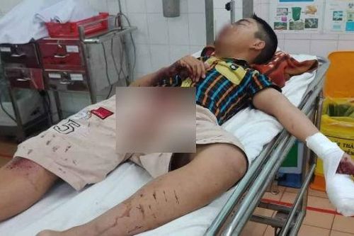 Đốt pháo tự chế, bé trai bị dập nát bàn tay