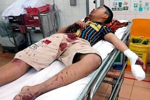 Dùng bột diêm chế thành pháo, bé trai bị chấn thương