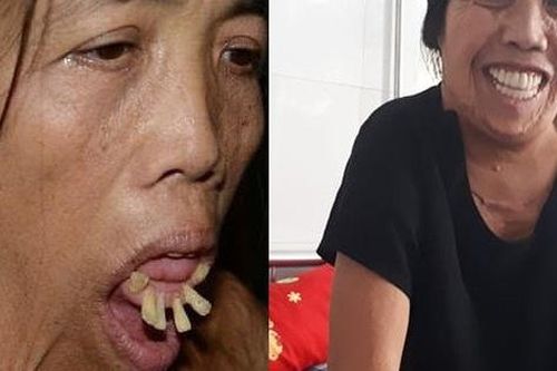 Chuyện chưa biết về hành trình làm lại khuôn mặt của người phụ nữ 50 năm không ngậm được miệng