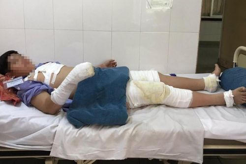 Bé trai 11 tuổi bỏng nặng nhiều vùng cơ thể vì nghịch cồn