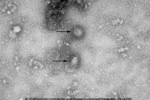Hướng dẫn Chẩn đoán và điều trị bệnh phổi do chủng virus Corona mới