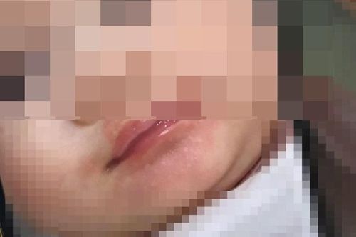 Bé gái 3 tháng nguy kịch sau khi uống sữa non Hàn Quốc
