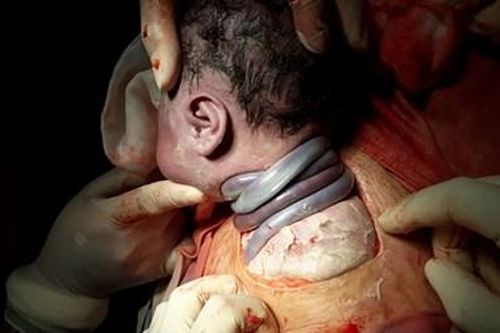 Bé trai chào đời ngày 29 Tết với dây rốn quấn cổ 3 vòng