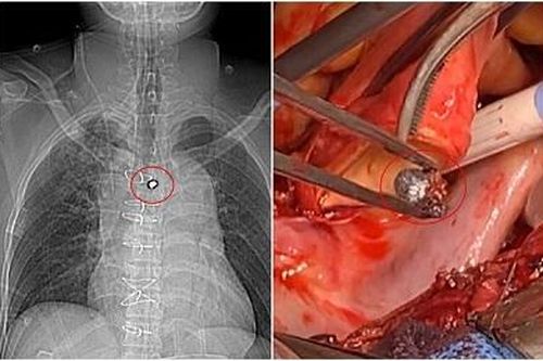 Sửa súng săn, đạn găm xuyên ngực