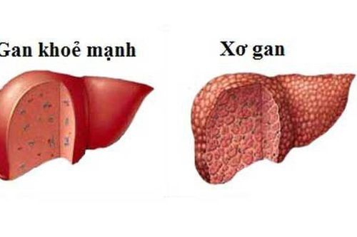 Xơ gan do rượu nguy hiểm thế nào?