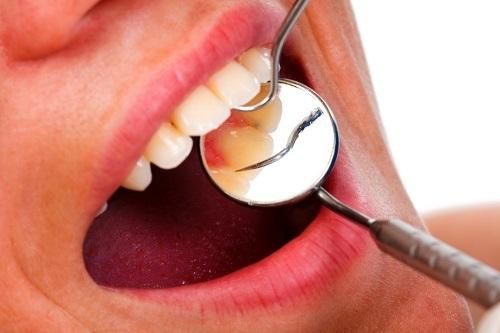 Biện pháp phòng ngừa viêm lợi