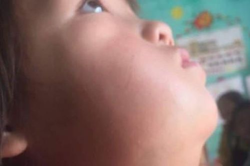 Xót thương bé gái vùng cao mồ côi mẹ, gương mặt méo lệch, nhà nghèo không có tiền chữa trị