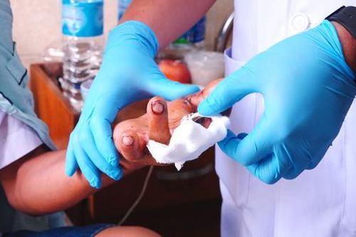 27 ca nhập viện do pháo nổ trong dịp Tết