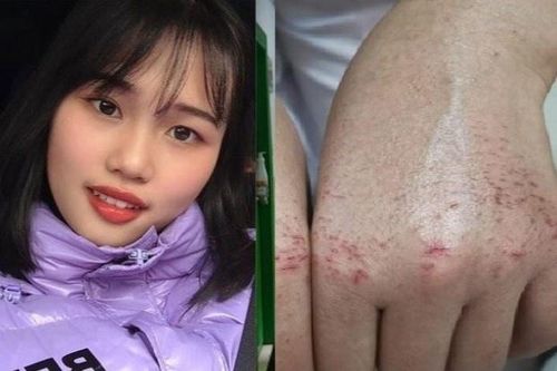 Làm việc đến tay rướm máu, nữ y tá trấn an bố mẹ: 'Bệnh nhân cần con'
