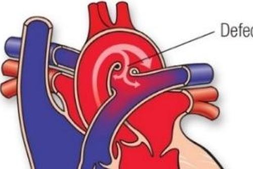 Những điều cần biết về còn ống động mạch