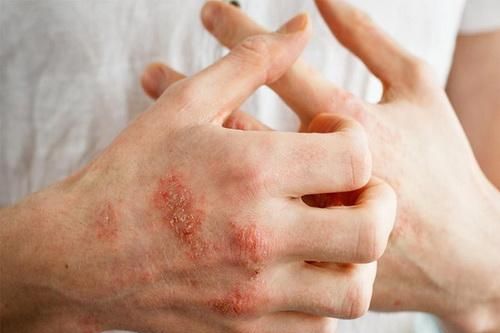 Ngăn ngừa bệnh chàm tái phát vào mùa lạnh, thuốc gì?