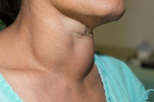 5 chị em cùng mắc bệnh tuyến giáp, 2 người bị ung thư