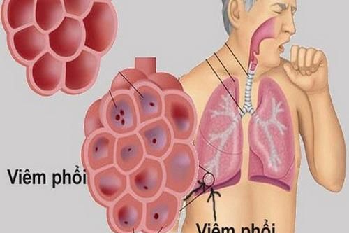 Mùa xuân, người cao tuổi cần đề phòng viêm phổi