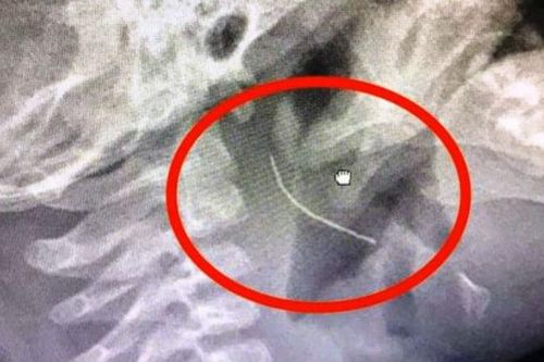 Mảnh thép 2cm nghi trong bát cháo mắc ở họng bé trai 13 tháng tuổi
