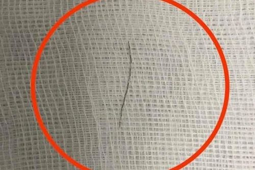 Phẫu thuật lấy đoạn thép dài gần 2cm trong họng bé 13 tháng tuổi