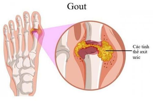 Tại sao nói Axit uric tăng cao gây bệnh gút là không thể xem thường?
