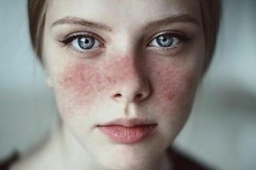Bệnh lupus ban đỏ nguy hiểm thế nào?