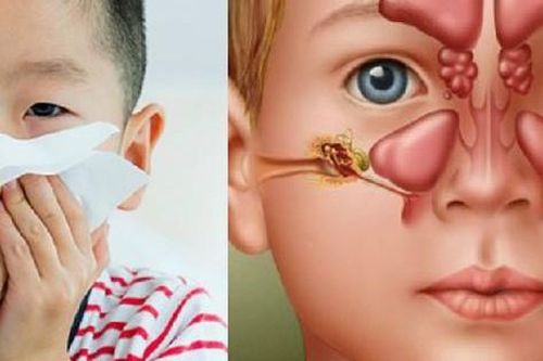 Viêm xoang ở trẻ em cần điều trị thế nào?