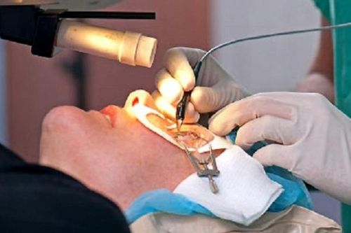 Phẫu thuật lasik có chữa khỏi cận thị?