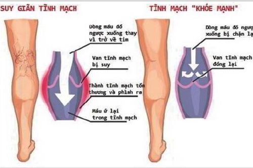 Phép trị viêm tắc tĩnh mạch của Đông y