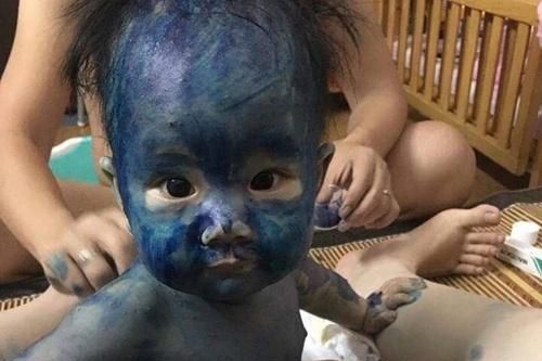 Sự thật về hai loại thuốc xanh, đỏ người mắc thủy đậu hay dùng